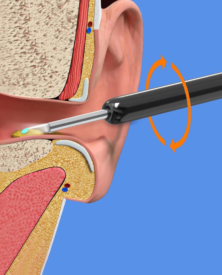 Limpiador de Oídos Con Cámara Endoscopio - Puro™